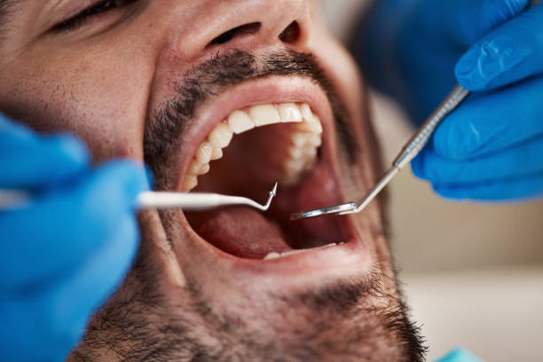Best Emergency Wisdom Teeth Removal in River Oaks, TX